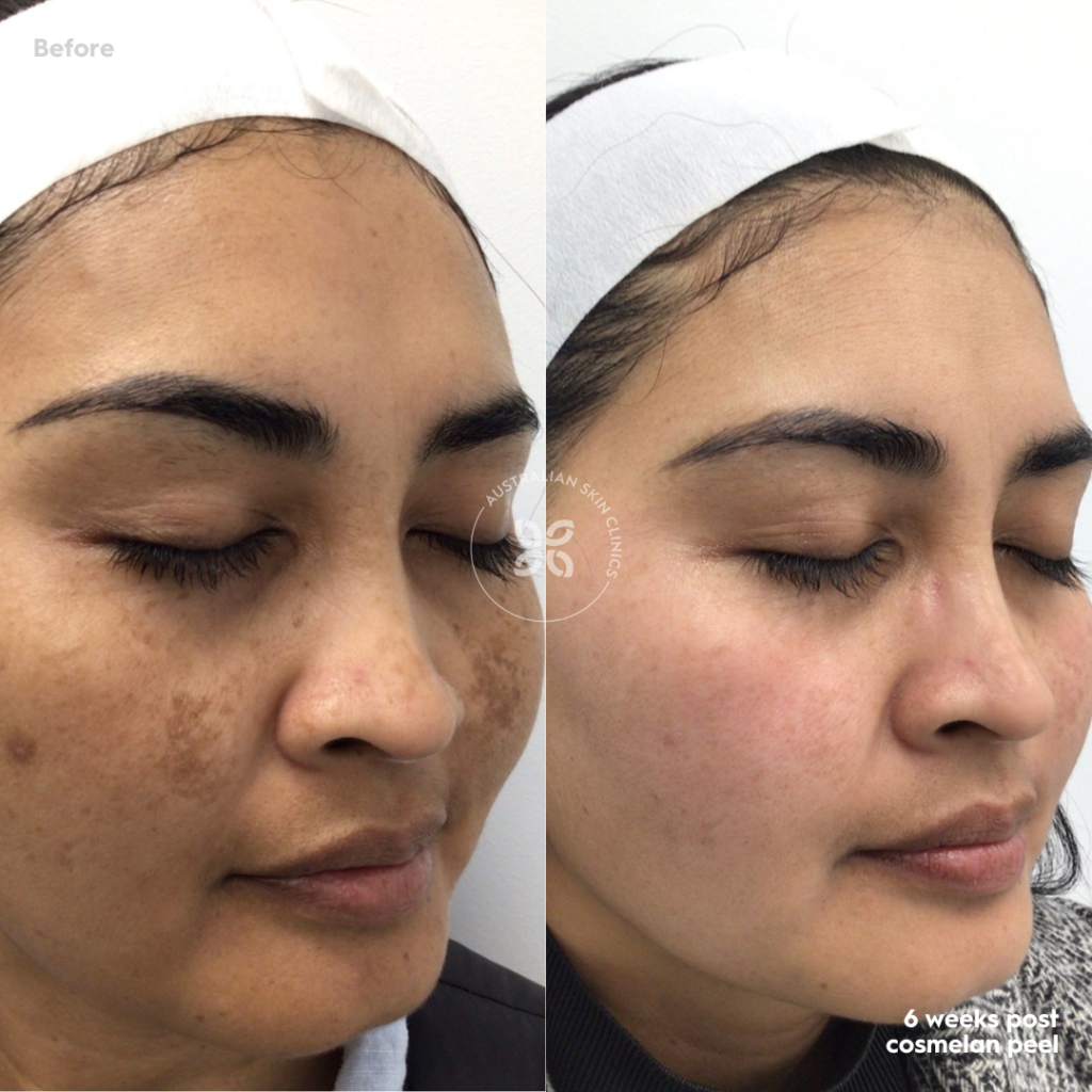 Cosmelan Before and After - reduce pigmentation by up to 95% - 5