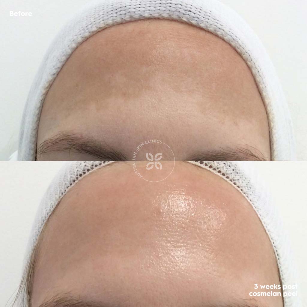 Cosmelan Before and After - reduce pigmentation 6