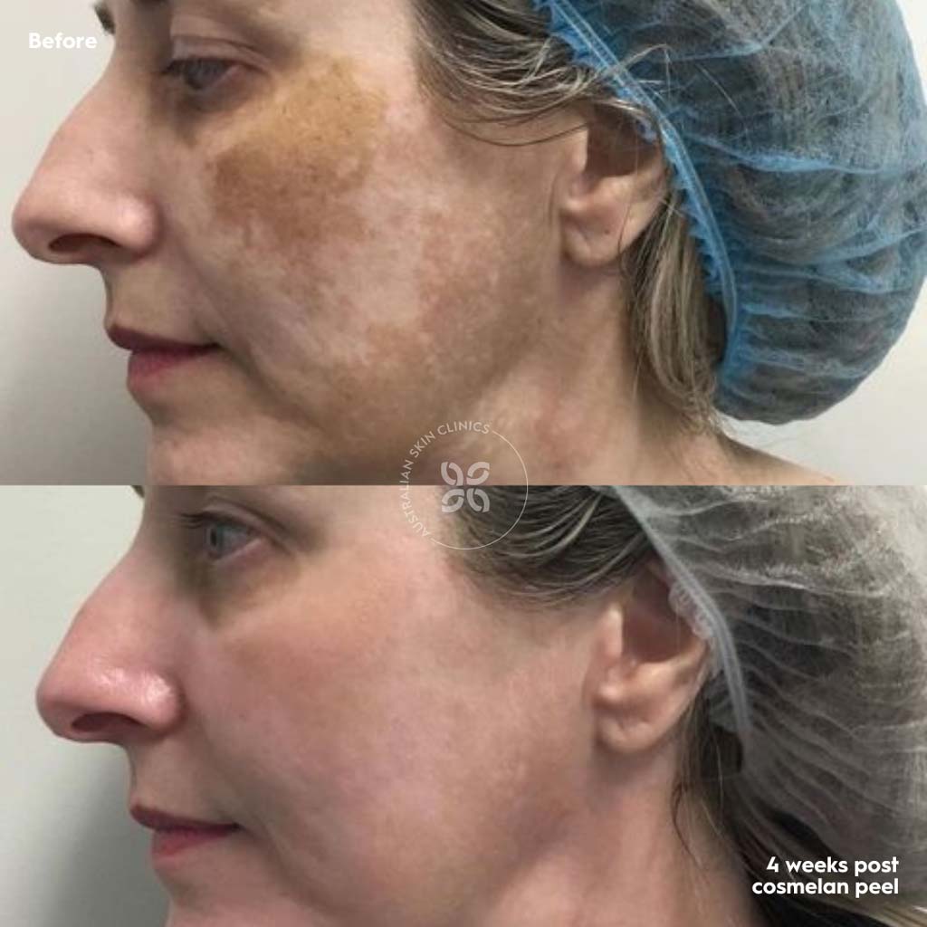 Cosmelan Before and After - reduce pigmentation by up to 95% - 7