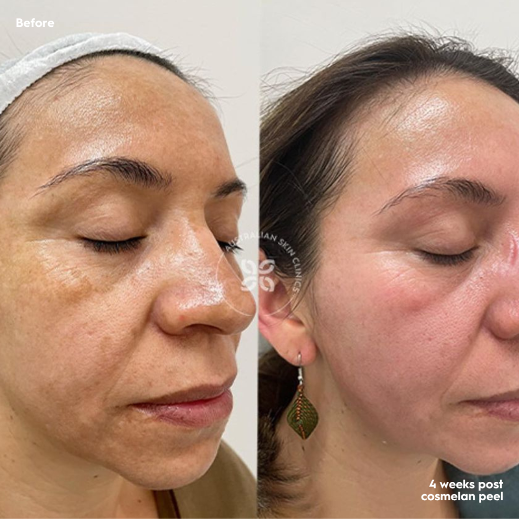 Cosmelan Before and After - reduce pigmentation by up to 95% - 8