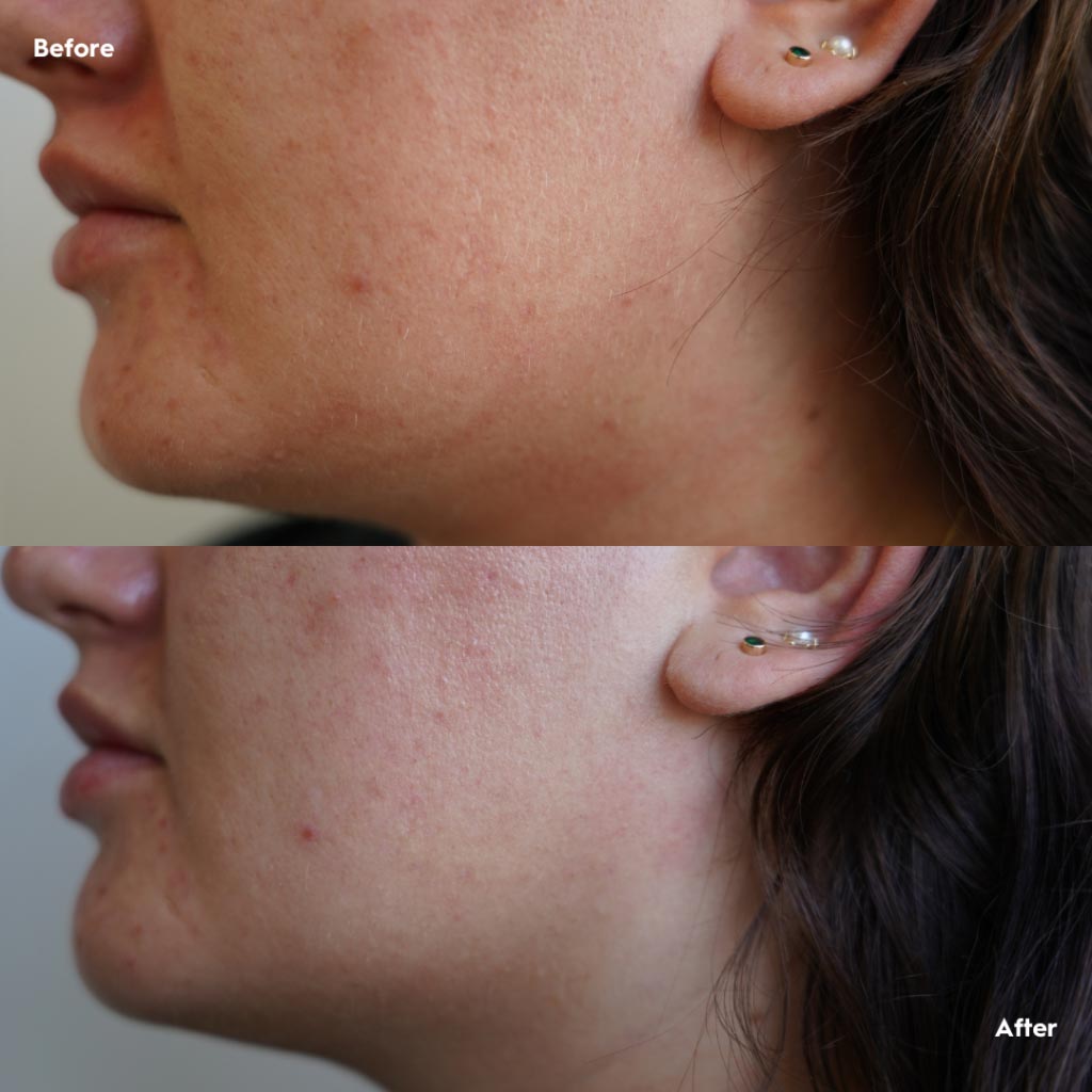 Before & After Dermaplanning Skin Treatments