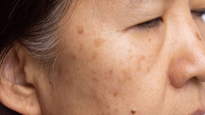 Age Spots Skin Treatment