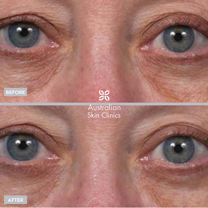 Before + After Thermage Skin Treatment