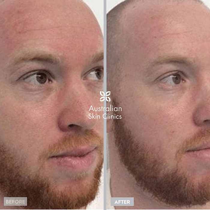 Laser for pigmentation before and after image