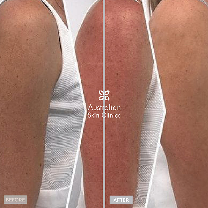 Laser for pigmentation before and after image - 3