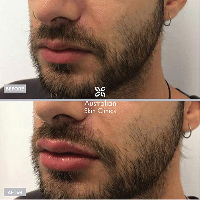 Lip Filler - Dermal Filler Injections Results before and after images 2