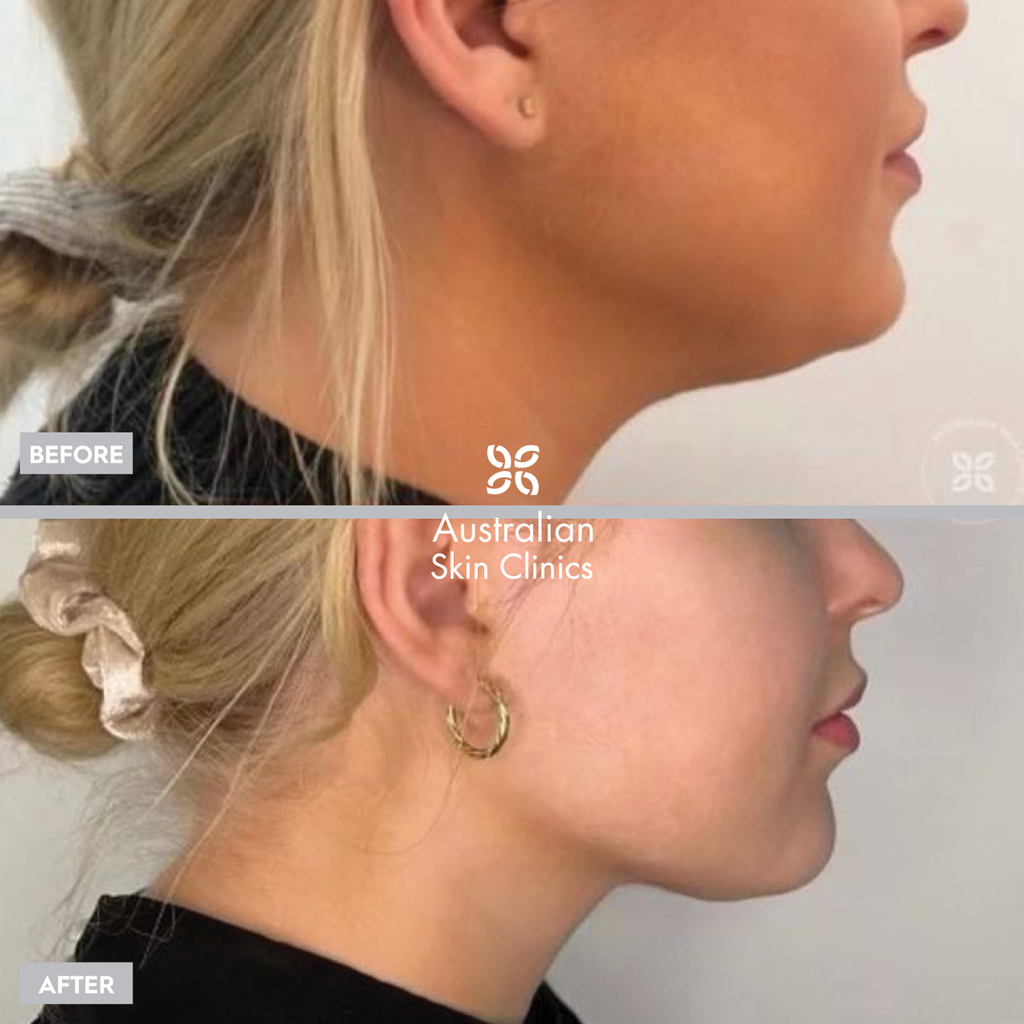 Chin Sculpting Before and After - Australian Skin Clinics