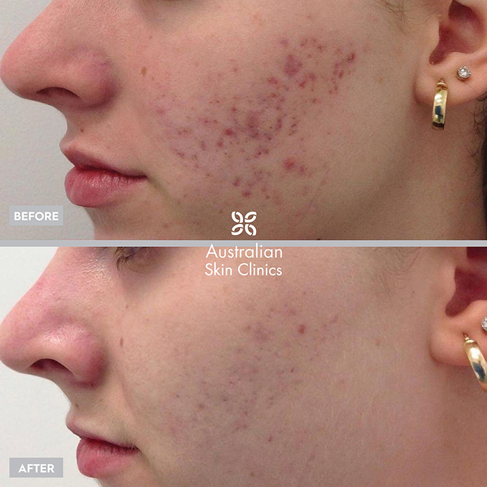 Before + After microneedling skin treatment