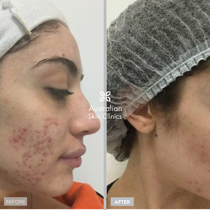 Before + After Microneedling Skin Treatment - Australian Skin Clinics (1)