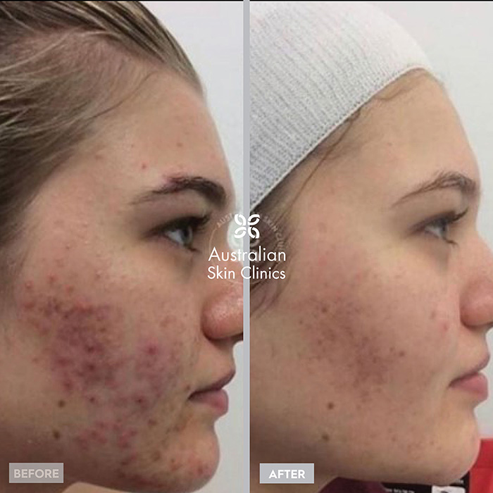 Before + After Microneedling Skin Treatment - Australian Skin Clinics (3)