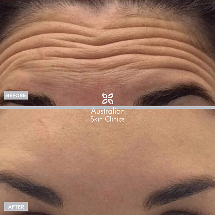 Anti-wrinkle skin injection results before and after -2