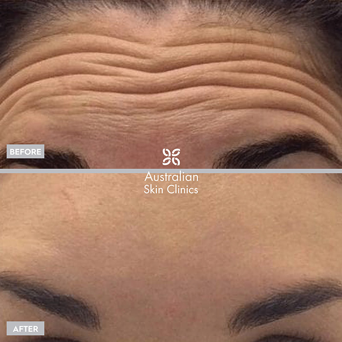 Anti-wrinkle Injections - Australian Skin Clinics