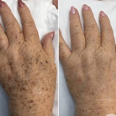 Laser for pigmentation on the hand before and after image