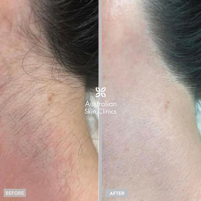 Laser Hair Removal - Australian Skin Clinics
