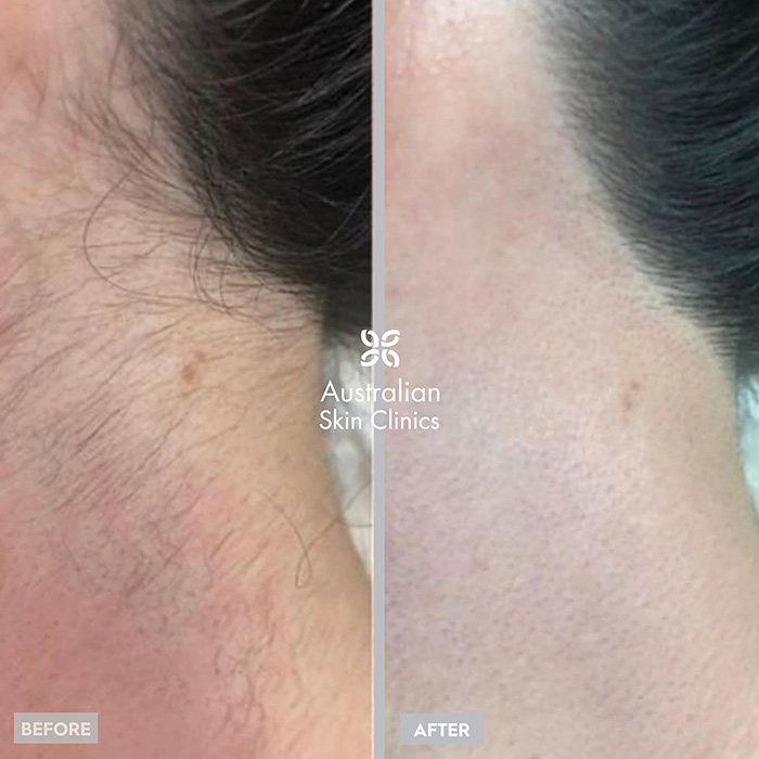 IPL Hair Removal - Full Leg