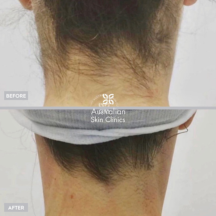 Laser Hair Removal Before and After Picture of Patient - 2
