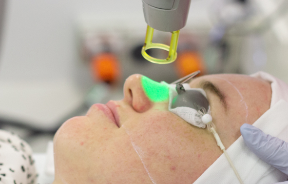 Laser for redness skin treatment