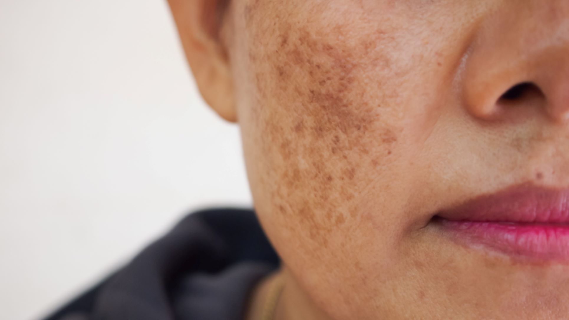 Melasma Skin Treatment