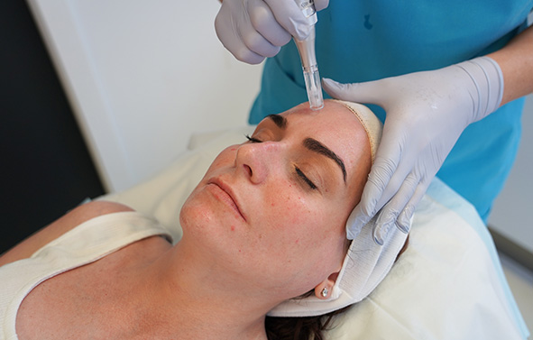 Microneedling - Back Featured Image
