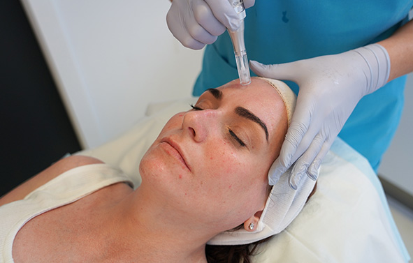 Microneedling - Full Face Featured Image