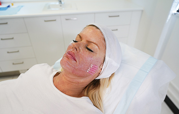 PDO Mono Threads to boost Collagen - Australian Skin Clinics