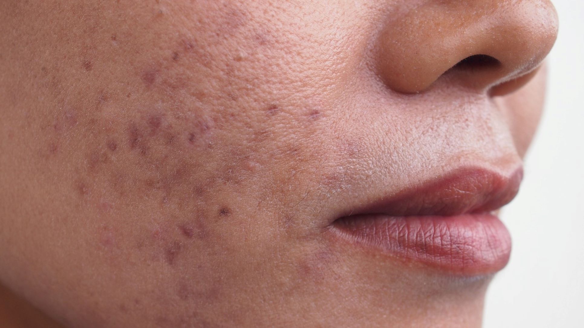 Post-Inflammatory Hyperpigmentation (PIH) Skin Treatment - PIH Acne