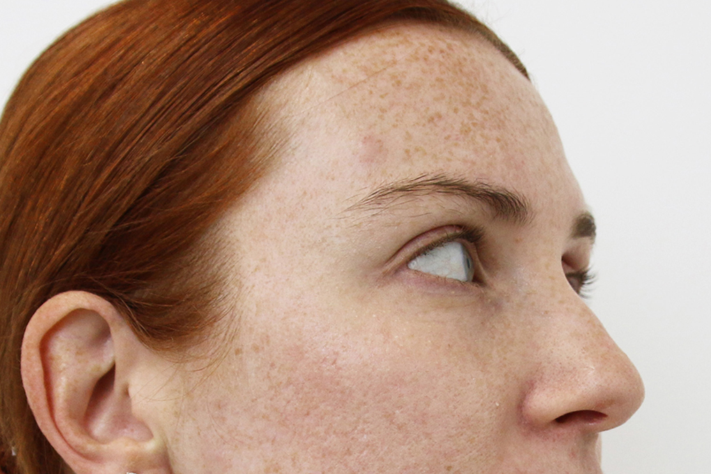 Pigmentation or Freckle Treatment