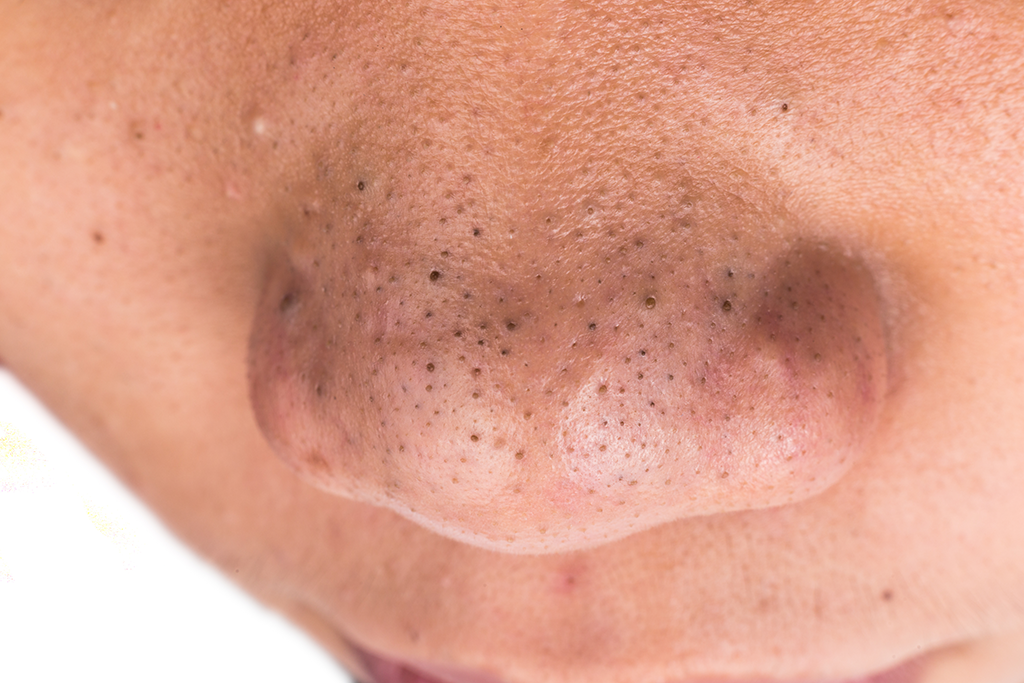 What Is A Blackheads at Mary Smyth blog