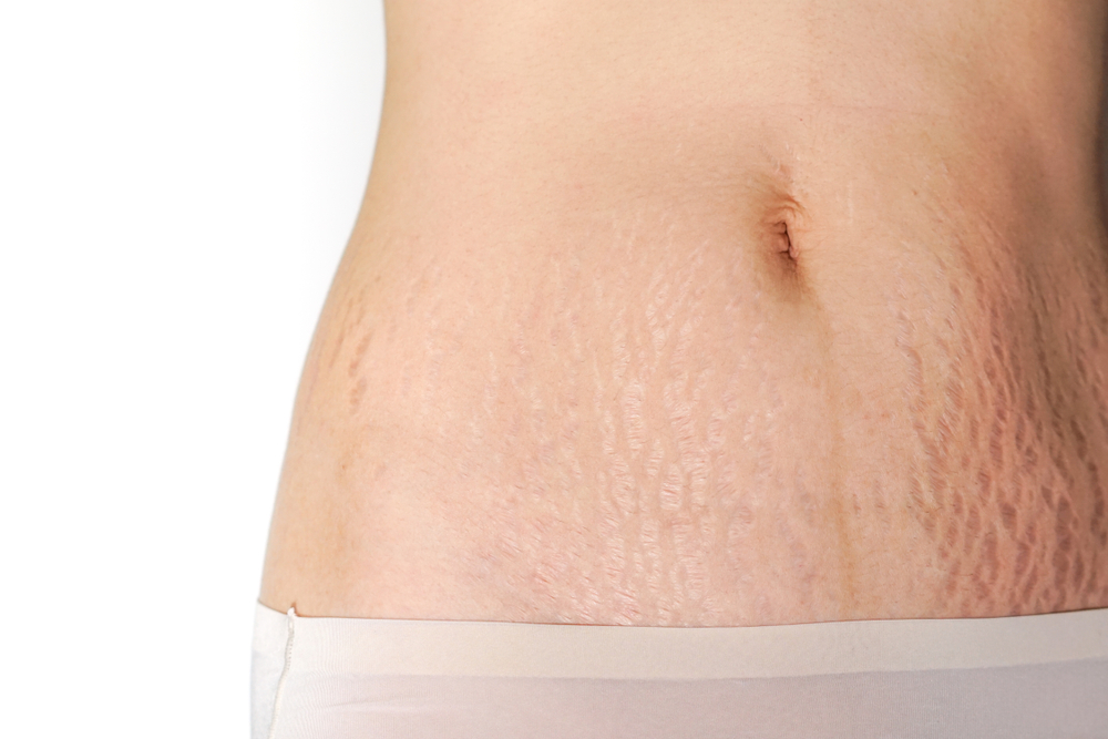 Stretch Mark Removal & Treatment Sydney