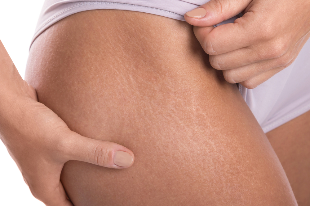 Stretch Marks - SKIN Clinics