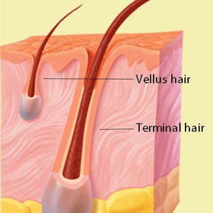 Electrolysis on vellus hair (female face) - YouTube