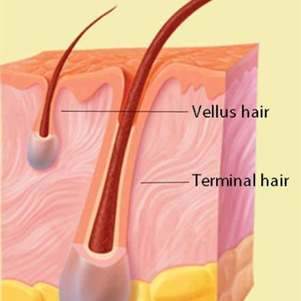 Group I patch A regrowth of vellus and terminal hair after first   Download Scientific Diagram