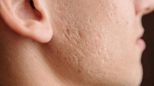 What Is Cigarette Paper Atrophic Scarring Scarring & Texture Correction | Australian Skin Clinics