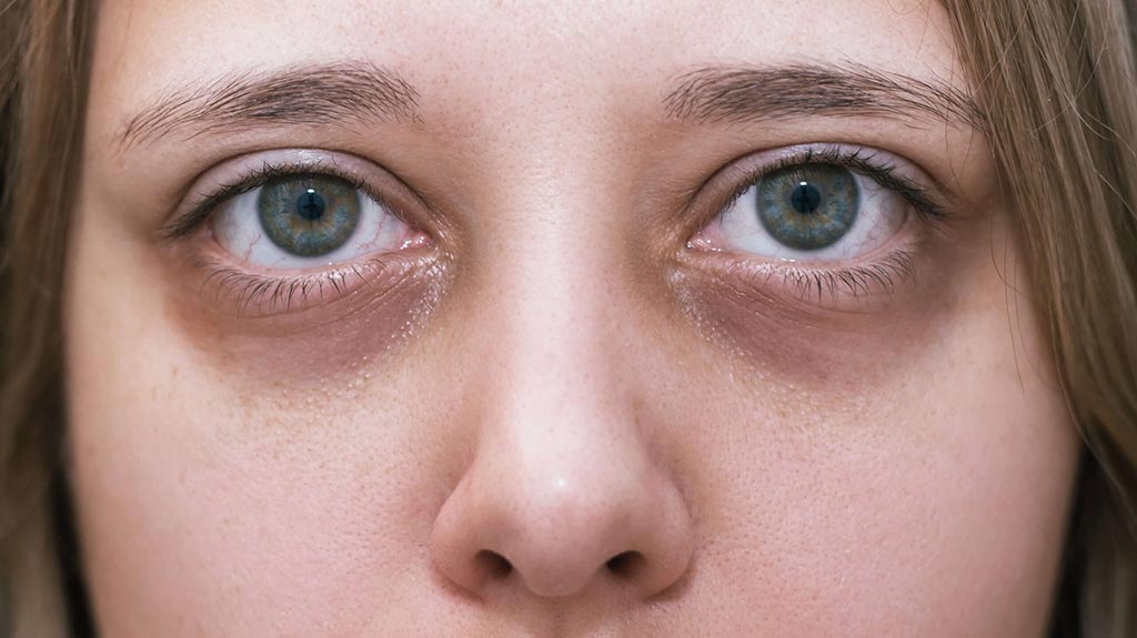 Dark Circles around Eyes Treatment