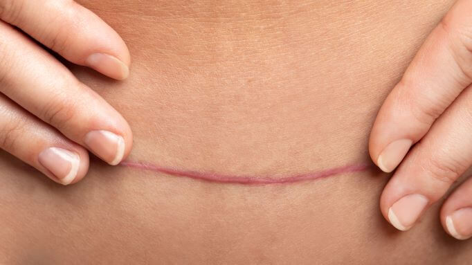 Hypertrophic Scars - Skin scarring Treatments - Australian Skin Clinics