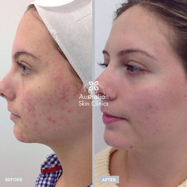 Microdermabrasion Australian Skin Clinics