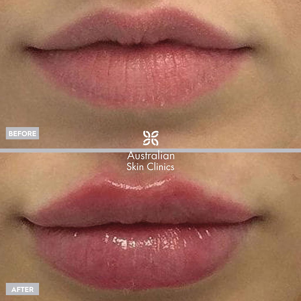 Before and After Lip Filler Injections 2-1
