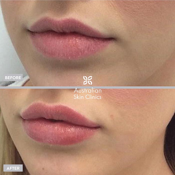 Before and After Images Lip Filler Injections