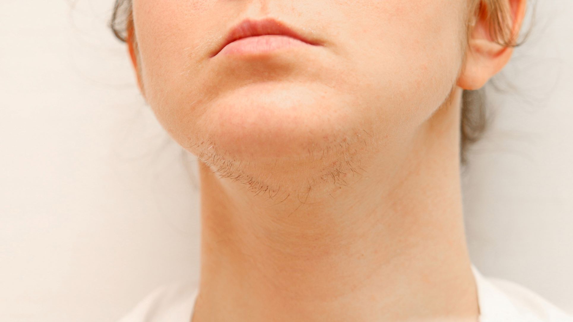 Unwanted Facial Hair - Laser Hair Removal