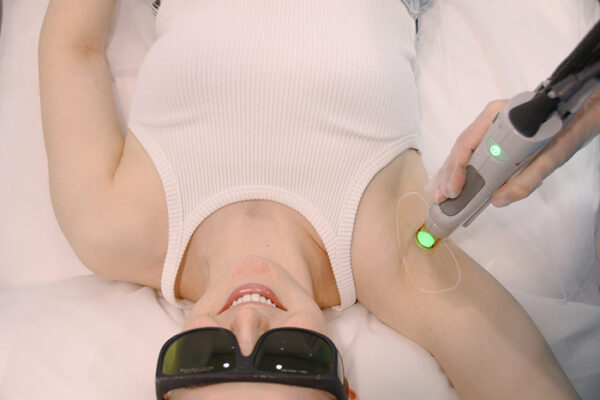 A Laser Technician is Processing Laser Hair Removal Treatment on a Patient’s Underarms