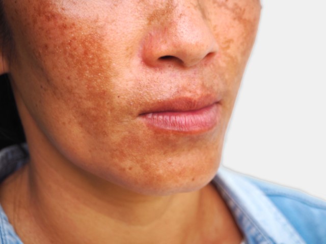 Pigmentation Treatment - Melasma Skin Problem