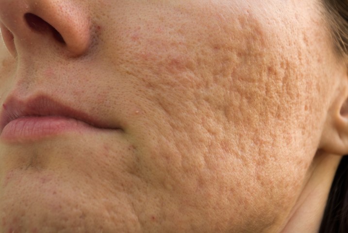 Skin scarring Treatments - Australian Skin Clinics