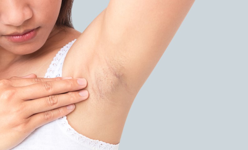 Underam Laser Hair Removal - Unwanted Hair