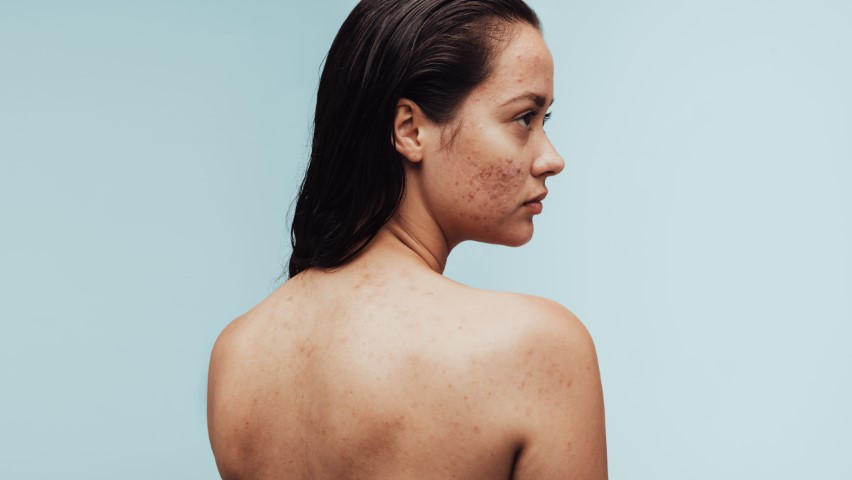 Acne Skin Treatments - Australian Skin Clinics