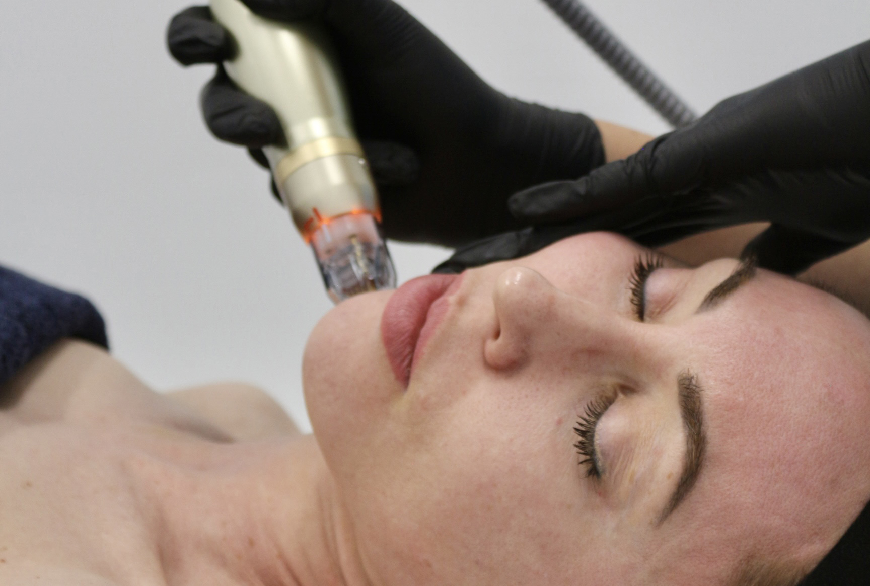 Sylfirm X Advanced RF Needling vs Fractional RF Needling: What’s the Difference?