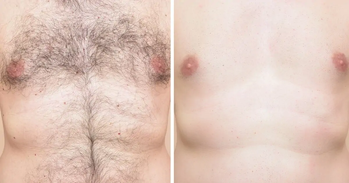 male laser hair removal before and after