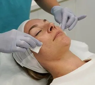 Acne peel Treatment image