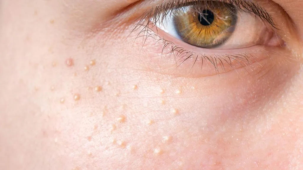 Skin Congestion Treatments