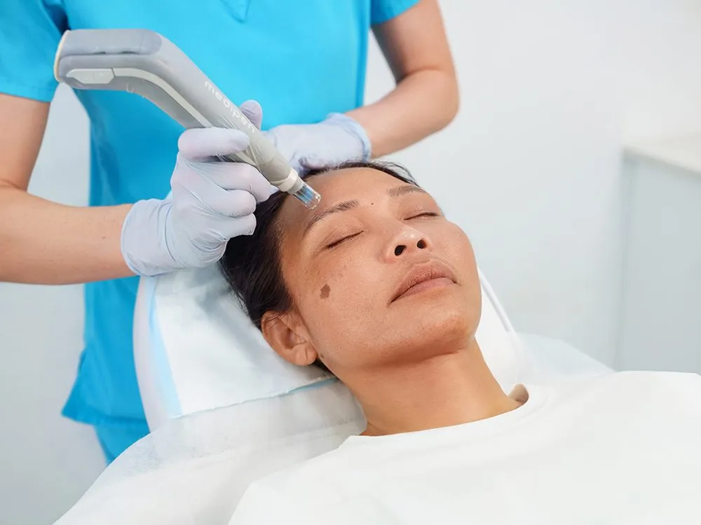 Microneedling Skin treatment